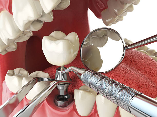Best Emergency Tooth Extraction in Robinwood, MD